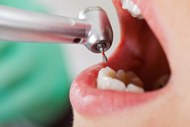 Best Emergency Tooth Extraction in Gorevle, IL